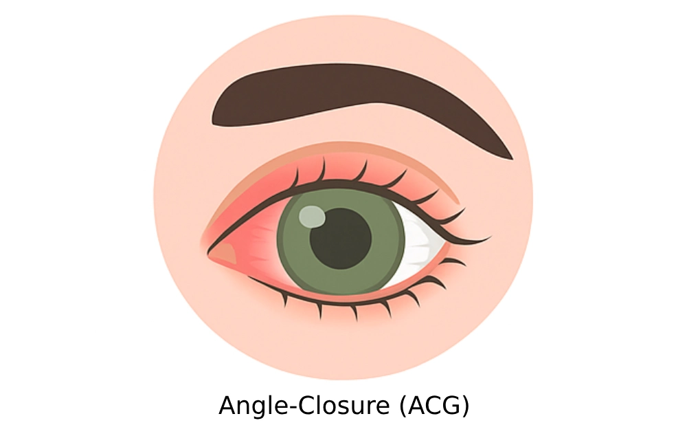Angle-Closure Glaucoma (ACG)