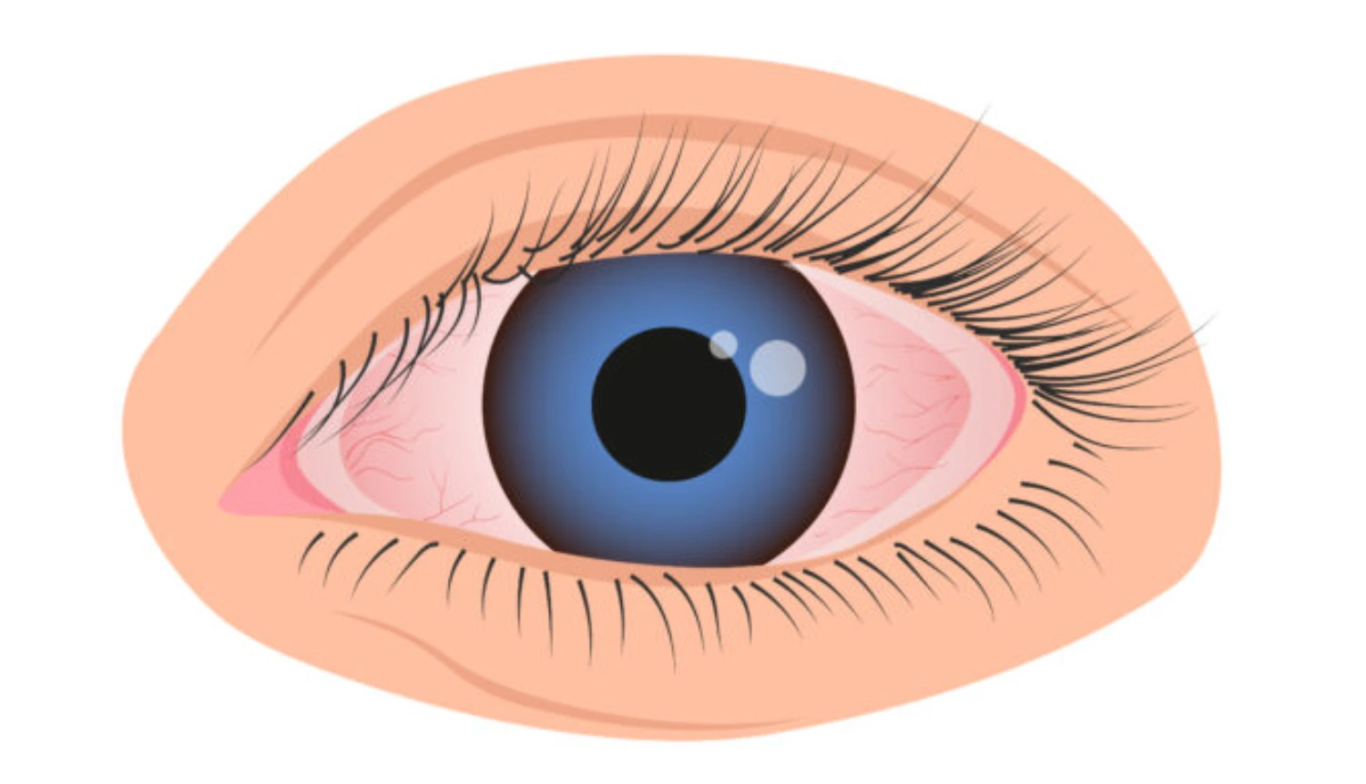 Aqueous Deficient Dry Eye