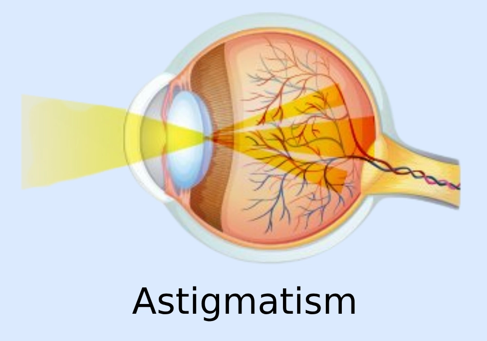 Astigmatism