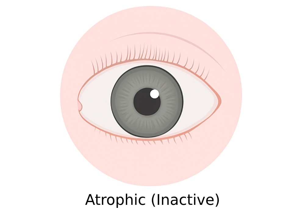 Atrophic (Inactive) Pterygium