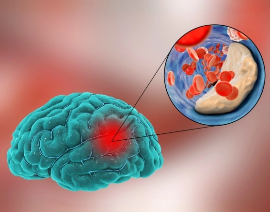Cerebrovascular Stroke