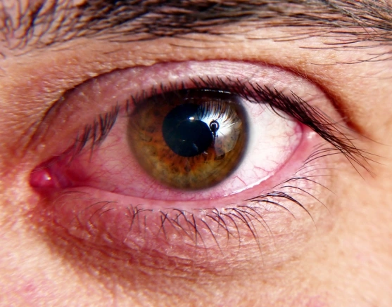 Dry Eye Image