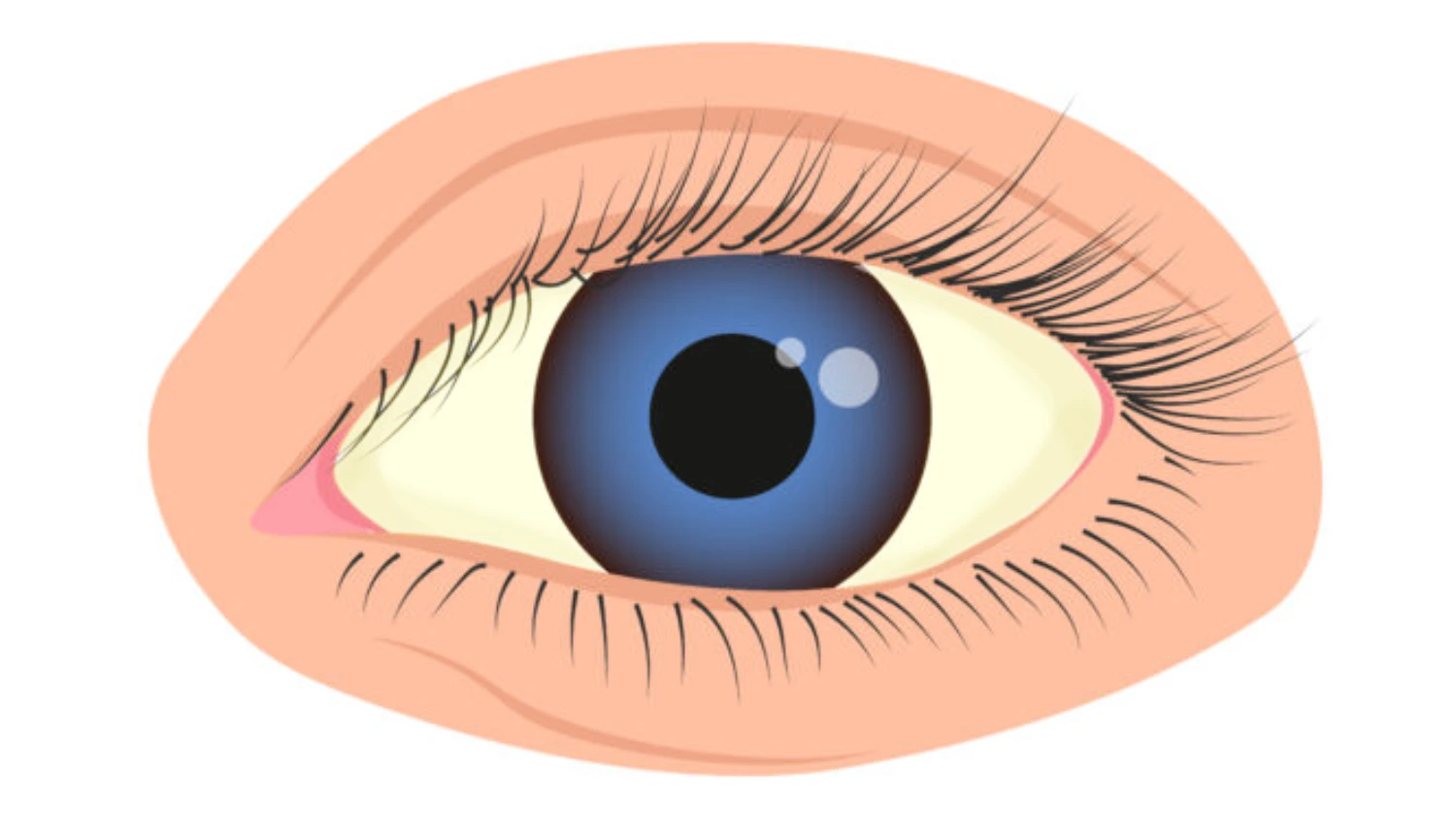 Evaporative Dry Eye