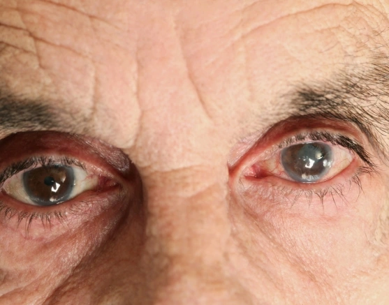 Glaucoma Image