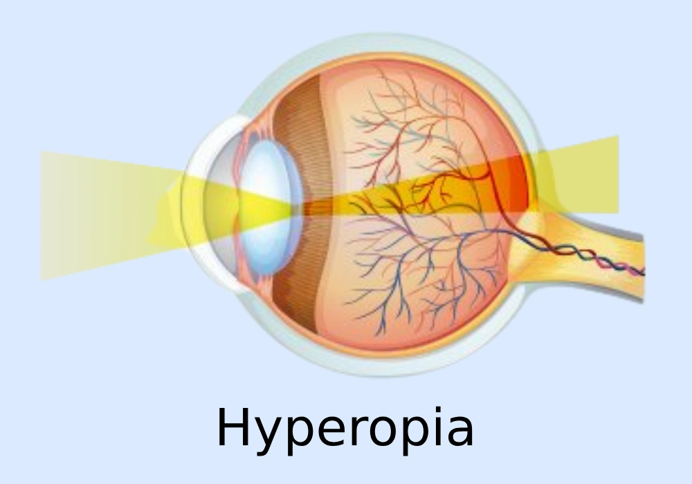 Hyperopia (Farsightedness)