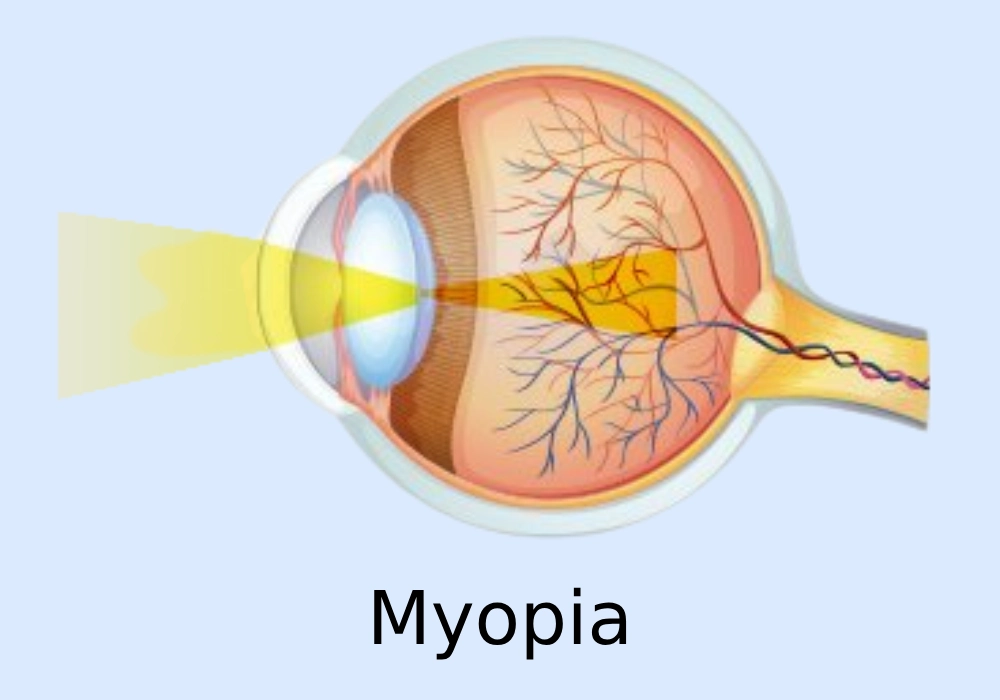 Myopia (Nearsightedness)