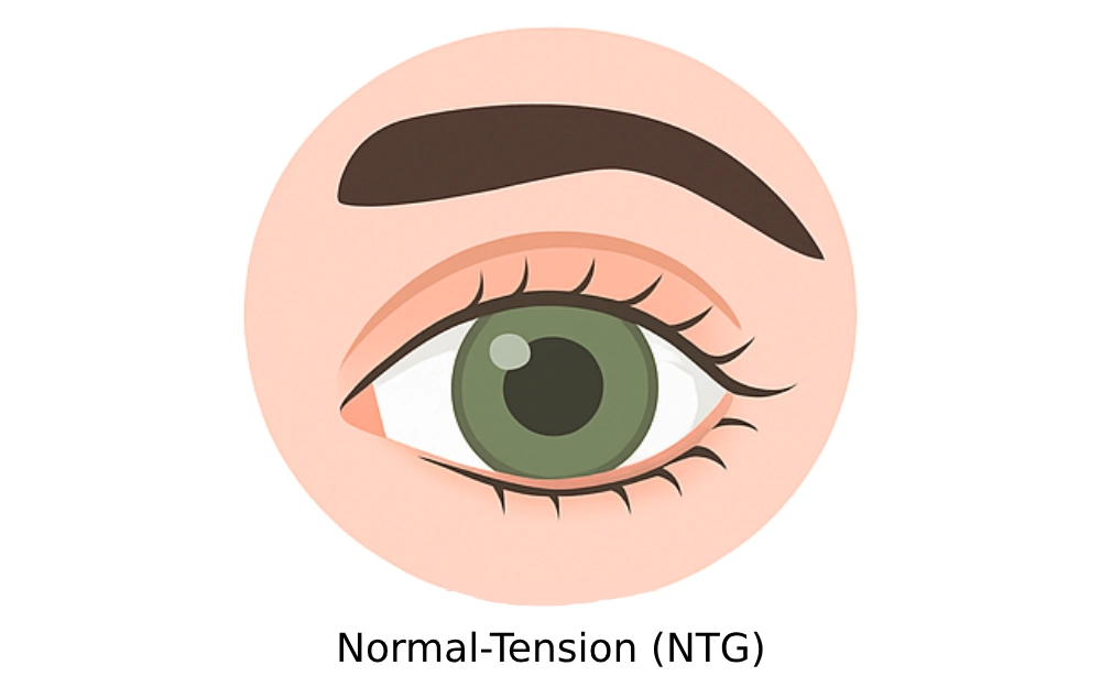 Normal-Tension Glaucoma (NTG)