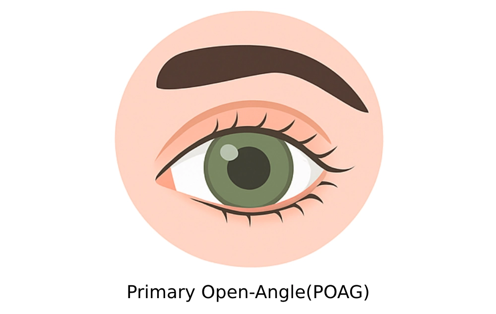 Primary Open-Angle (POAG)