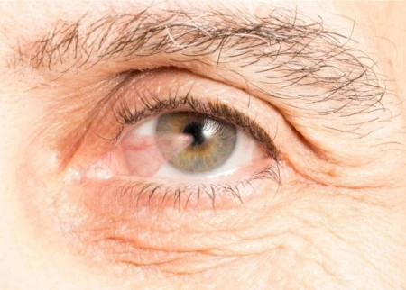 EYE SURGERY